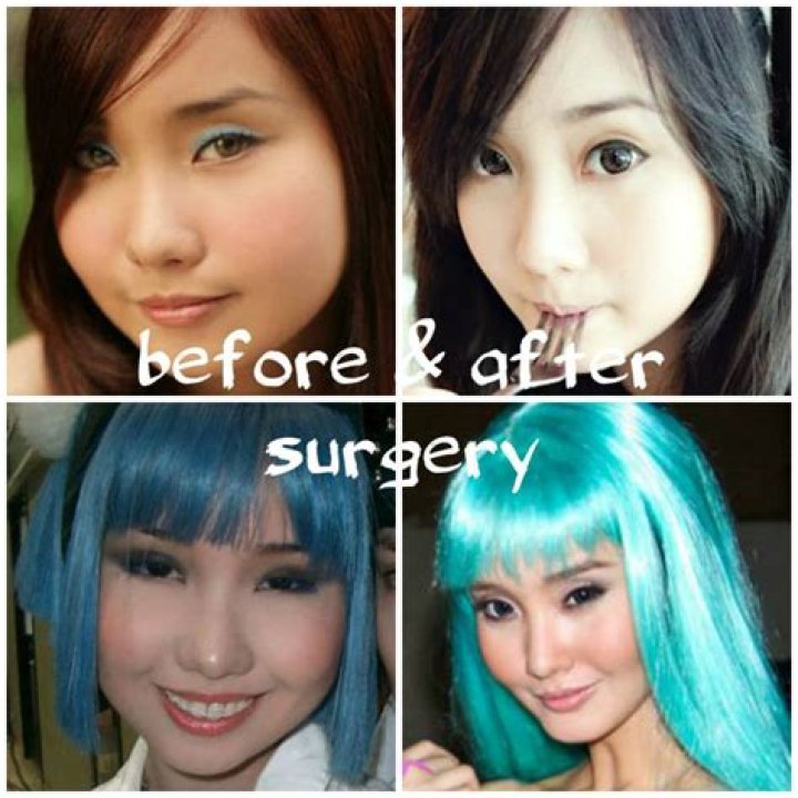 Alodia Gosiengfiao Plastic Surgery: Before And After Photos
